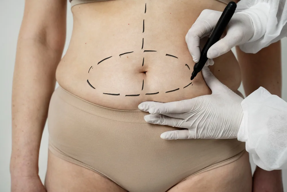 Abdominoplastia, braquioplastia y cruroplastia en CDMX