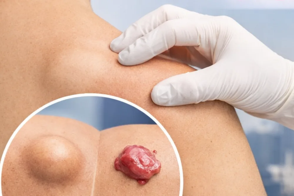 Lipomas o tumores de piel en CDMX