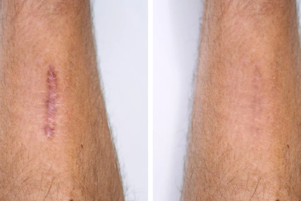 Remodelación de cicatrices en CDMX